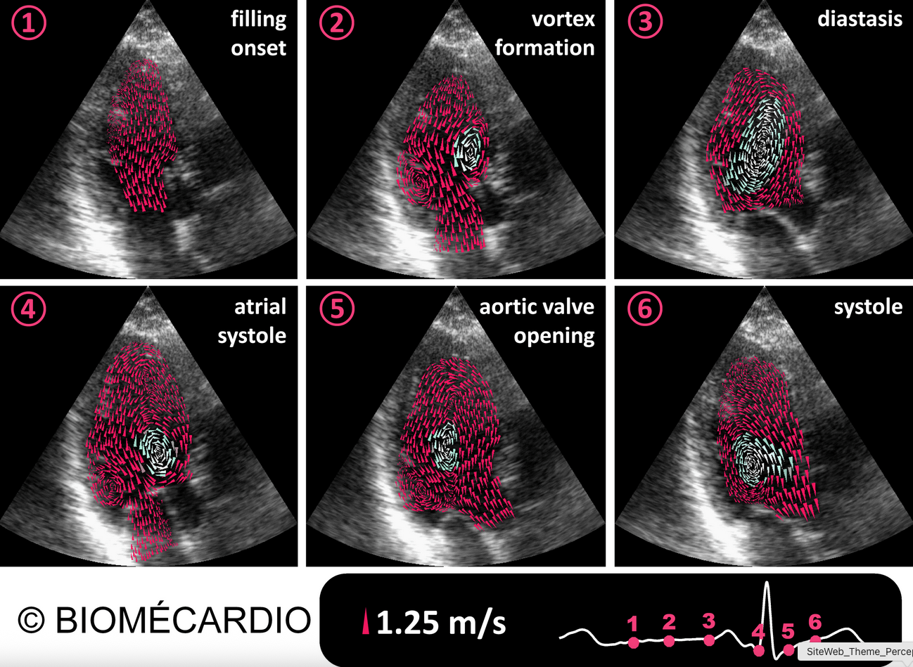 Intraventricular vector flow mapping (iVFM): from standard methods to AI and clinical translation
